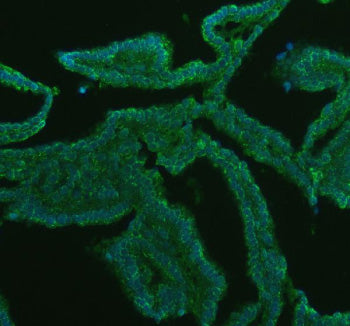 Immunofluorescent staining of GATM using anti-GATM antibody (green). GATM was detected in a paraffin-embedded section of human breast cancer tissue. Heat mediated antigen retrieval was performed in EDTA buffer (pH 8.0, epitope retrieval solution). The tissue section was blocked with 10% goat serum. The tissue section was then incubated with 5 ug/ml rabbit anti-GATM antibody overnight at 4oC.
