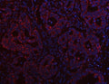 Immunofluorescent staining of FFPE human rectal cancer tissue with PTPIP51 antibody (red) and DAPI nuclear stain (blue). HIER: steam section in pH8 EDTA buffer for 20 min.