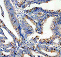 Immunohistochemical staining of SPINK4 using anti-SPINK4 antibody. SPINK4 was detected in a paraffin-embedded section of human colon cancer tissue. Heat mediated antigen retrieval was performed in EDTA buffer (pH 8.0, epitope retrieval solution). The tissue section was blocked with 10% goat serum. The tissue section was then incubated with 2 ug/ml rabbit anti-SPINK4 antibody overnight at 4oC. Peroxidase Conjugated Goat Anti-rabbit IgG was used as secondary antibody and incubated for 30 min at 37oC.