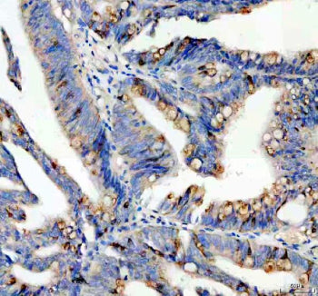 Immunohistochemical staining of SPINK4 using anti-SPINK4 antibody. SPINK4 was detected in a paraffin-embedded section of human colon cancer tissue. Heat mediated antigen retrieval was performed in EDTA buffer (pH 8.0, epitope retrieval solution). The tissue section was blocked with 10% goat serum. The tissue section was then incubated with 2 ug/ml rabbit anti-SPINK4 antibody overnight at 4oC. Peroxidase Conjugated Goat Anti-rabbit IgG was used as secondary antibody and incubated for 30 min at 37oC.