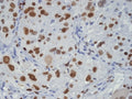 IHC staining of FFPE human glioma tissue with TAR DNA binding protein 43 antibody, HRP-secondary and DAB substrate. HIER: boil tissue sections in pH8 EDTA for 20 min and allow to cool before testing.