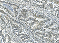 IHC staining of FFPE human rectal cancer with ATF1 antibody. HIER: boil tissue sections in pH8 EDTA for 20 min and allow to cool before testing.