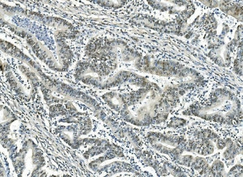 IHC staining of FFPE human rectal cancer with ATF1 antibody. HIER: boil tissue sections in pH8 EDTA for 20 min and allow to cool before testing.