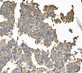 IHC staining of FFPE human rectal cancer with CLDN5 antibody. HIER: boil tissue sections in pH8 EDTA for 20 min and allow to cool before testing.