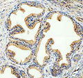 IHC analysis of NCOA2 using anti-NCOA2 antibody. NCOA2 was detected in a paraffin-embedded section of human prostate hyperplasia cancer tissue. Heat mediated antigen retrieval was performed in EDTA buffer (pH 8.0, epitope retrieval solution). The tissue section was blocked with 10% goat serum. The tissue section was then incubated with 2 ug/ml rabbit anti-NCOA2 antibody overnight at 4oC. Peroxidase Conjugated Goat Anti-rabbit IgG was used as secondary antibody and incubated for 30 min at 37oC.