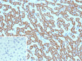 IHC staining of FFPE human hepatocellular carcinoma tissue with Carbamoyl phosphate synthetase 1 antibody (clone CPS1/9865). Inset: PBS used in place of primary Ab (secondary Ab negative control). HIER: boil tissue sections in pH 9 10mM Tris with 1mM EDTA for 20 min and allow to cool before testing.