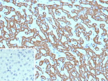 IHC staining of FFPE human hepatocellular carcinoma tissue with Carbamoyl phosphate synthetase 1 antibody (clone CPS1/9865). Inset: PBS used in place of primary Ab (secondary Ab negative control). HIER: boil tissue sections in pH 9 10mM Tris with 1mM EDTA for 20 min and allow to cool before testing.