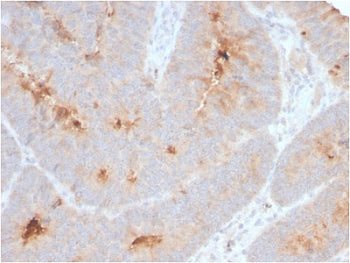 IHC staining of FFPE human colon carcinoma with recombinant ECM1 antibody. HIER: boil tissue sections in pH 9 10mM Tris with 1mM EDTA for 10-20 min and allow to cool before testing.
