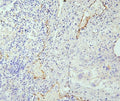 IHC staining of FFPE human lung cancer with eNOS antibody. HIER: boil tissue sections in pH6, 10mM citrate buffer, for 20 min and allow to cool before testing.