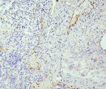 IHC staining of FFPE human lung cancer with eNOS antibody. HIER: boil tissue sections in pH6, 10mM citrate buffer, for 20 min and allow to cool before testing.