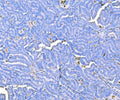 IHC staining of FFPE human ovarian cancer tissue with Prothrombin antibody. HIER: boil tissue sections in pH8 EDTA for 20 min and allow to cool before testing.