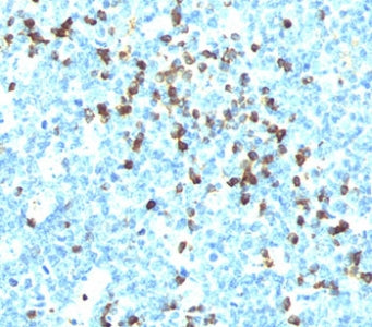 IHC testing of tonsil stained with Lambda Light Chain antibody (LcN-2). Note cell membrane & cytoplasmic staining.