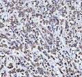 Immunohistochemical staining of AHCY using anti-AHCY antibody. AHCY was detected in a paraffin-embedded section of human breast cancer tissue. Heat mediated antigen retrieval was performed in EDTA buffer (pH 8.0, epitope retrieval solution). The tissue section was blocked with 10% goat serum. The tissue section was then incubated with 2 ug/ml rabbit anti-AHCY antibody overnight at 4oC. Peroxidase Conjugated Goat Anti-rabbit IgG was used as secondary antibody and incubated for 30 min at 37oC.