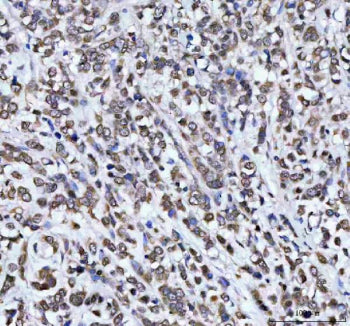 Immunohistochemical staining of AHCY using anti-AHCY antibody. AHCY was detected in a paraffin-embedded section of human breast cancer tissue. Heat mediated antigen retrieval was performed in EDTA buffer (pH 8.0, epitope retrieval solution). The tissue section was blocked with 10% goat serum. The tissue section was then incubated with 2 ug/ml rabbit anti-AHCY antibody overnight at 4oC. Peroxidase Conjugated Goat Anti-rabbit IgG was used as secondary antibody and incubated for 30 min at 37oC.