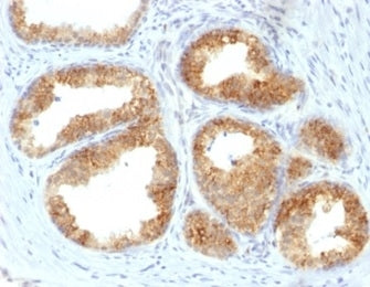 IHC staining of FFPE human prostate cancer with COX2 antibody (clone COX2/2377). HIER: boil tissue sections in pH 9 10mM Tris with 1mM EDTA for 20 min and allow to cool before testing.