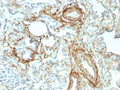 IHC staining of FFPE human angiosarcoma with Elastin antibody (clone ELN/2069). HIER: boil tissue sections in pH 9 10mM Tris with 1mM EDTA for 20 min and allow to cool before testing.