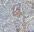 Immunohistochemical staining of ACE using anti-ACE antibody. ACE was detected in a paraffin-embedded section of human thyroid cancer tissue. Heat mediated antigen retrieval was performed in EDTA buffer (pH 8.0, epitope retrieval solution). The tissue section was blocked with 10% goat serum. The tissue section was then incubated with 2 ug/ml rabbit anti-ACE antibody overnight at 4oC. Peroxidase Conjugated Goat Anti-rabbit IgG was used as secondary antibody and incubated for 30 min at 37oC.
