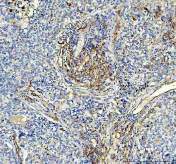 Immunohistochemical staining of ACE using anti-ACE antibody. ACE was detected in a paraffin-embedded section of human thyroid cancer tissue. Heat mediated antigen retrieval was performed in EDTA buffer (pH 8.0, epitope retrieval solution). The tissue section was blocked with 10% goat serum. The tissue section was then incubated with 2 ug/ml rabbit anti-ACE antibody overnight at 4oC. Peroxidase Conjugated Goat Anti-rabbit IgG was used as secondary antibody and incubated for 30 min at 37oC.
