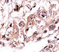 IHC analysis of FFPE human hepatocarcinoma stained with the PPP3CC antibody