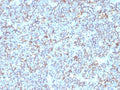 IHC: Formalin-fixed, paraffin-embedded human Ewing's sarcoma stained with anti-CD99 antibody (SPM596).