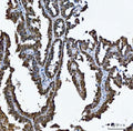 IHC staining of FFPE human ovarian cancer tissue with MRPP1 antibody. HIER: boil tissue sections in pH8 EDTA for 20 min and allow to cool before testing.