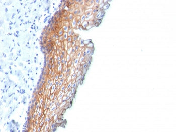 IHC staining of FFPE human esophageal carcinoma with Desmoglein 3 antibody (clone DSG3/2838). HIER: boil tissue sections in pH 9 10mM Tris with 1mM EDTA for 10-20 min and allow to cool before testing.
