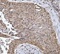 IHC staining of FFPE human esophageal squamous carcinoma tissue with YWHAG antibody. HIER: boil tissue sections in pH8 EDTA for 20 min and allow to cool before testing.