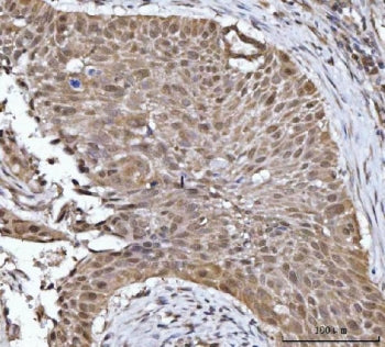 IHC staining of FFPE human esophageal squamous carcinoma tissue with YWHAG antibody. HIER: boil tissue sections in pH8 EDTA for 20 min and allow to cool before testing.