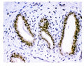 IHC staining of FFPE human breast cancer tissue with KDM5B antibody. HIER: boil tissue sections in pH8 EDTA for 20 min and allow to cool before testing.