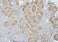 IHC staining of FFPE human breast cancer with IQGAP1 antibody at 1ug/ml. HIER: boil tissue sections in pH6, 10mM citrate buffer, for 10-20 min and allow to cool before testing.