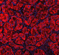 Immunofluorescent staining of MVK using anti-MVK antibody (red). MVK was detected in a paraffin-embedded section of human liver cancer tissue. Heat mediated antigen retrieval was performed in EDTA buffer (pH 8.0, epitope retrieval solution). The tissue section was blocked with 10% goat serum. The tissue section was then incubated with 5 ug/ml rabbit anti-MVK antibody overnight at 4oC. Cy3 Conjugated Goat Anti-Rabbit IgG was used as secondary antibody at 1:500 dilution and incubated for 30 min at 37oC.