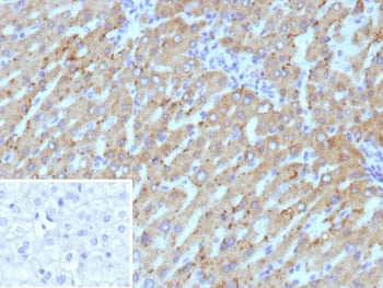 IHC staining of FFPE human hepatocellular carcinoma tissue with Hydroxysteroid 17-beta dehydrogenase 13 antibody (clone HSD17B13/13108). Inset: PBS used in place of primary Ab (secondary Ab negative control). HIER: boil tissue sections in pH 9 10mM Tris with 1mM EDTA for 20 min and allow to cool before testing.