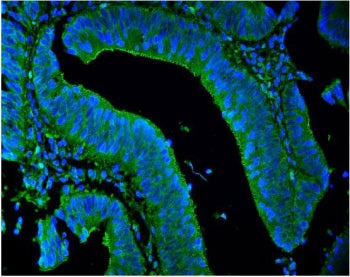 Immunofluorescent staining of FFPE human intestinal cancer with LPP antibody (green) and DAPI nuclear stain (blue). HIER: steam section in pH8 EDTA for 20 min.