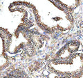 IHC analysis of PAM using anti-PAM antibody. PAM was detected in a paraffin-embedded section of human prostate cancer tissue. Heat mediated antigen retrieval was performed in EDTA buffer (pH 8.0, epitope retrieval solution). The tissue section was blocked with 10% goat serum. The tissue section was then incubated with 2 ug/ml rabbit anti-PAM antibody overnight at 4oC. Peroxidase Conjugated Goat Anti-rabbit IgG was used as secondary antibody and incubated for 30 min at 37oC.