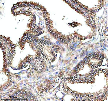 IHC analysis of PAM using anti-PAM antibody. PAM was detected in a paraffin-embedded section of human prostate cancer tissue. Heat mediated antigen retrieval was performed in EDTA buffer (pH 8.0, epitope retrieval solution). The tissue section was blocked with 10% goat serum. The tissue section was then incubated with 2 ug/ml rabbit anti-PAM antibody overnight at 4oC. Peroxidase Conjugated Goat Anti-rabbit IgG was used as secondary antibody and incubated for 30 min at 37oC.