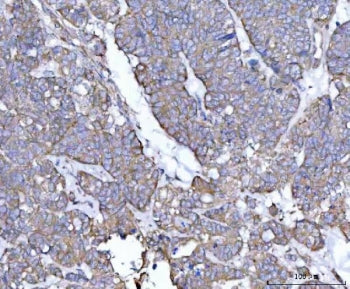IHC staining of FFPE human ovarian cancer tissue with Tollip antibody. HIER: boil tissue sections in pH8 EDTA for 20 min and allow to cool before testing.