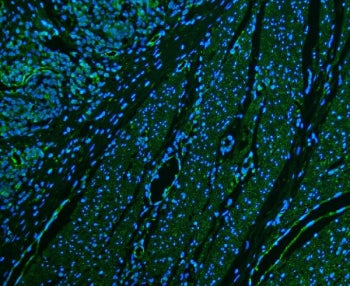 Immunofluorescent staining of FFPE human colon cancer with CD39 antibody (green) and DAPI nuclear stain (blue). HIER: steam section in pH6 citrate buffer for 20 min.