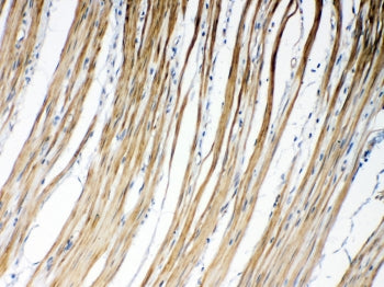 IHC testing of FFPE human intestinal cancer tissue with GJC1 antibody at 1ug/ml. Required HIER: steam section in pH6 citrate buffer for 20 min and allow to cool prior to testing.