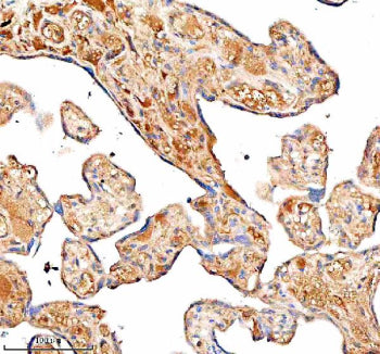 Immunohistochemical staining of SERPING1/C1 using anti-C1 Inhibitor (C1-INH) antibody. SERPING1/C1 was detected in a paraffin-embedded section of human cervical cancer tissue. Heat mediated antigen retrieval was performed in EDTA buffer (pH 8.0, epitope retrieval solution). The tissue section was blocked with 10% goat serum. The tissue section was then incubated with 1:100 rabbit anti-C1 Inhibitor (C1-INH) antibody overnight at 4oC.