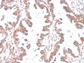 IHC staining of FFPE human ovary with GDF9 antibody. HIER: boil tissue sections in pH 9 10mM Tris with 1mM EDTA for 20 min and allow to cool before testing.