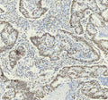 IHC analysis of HNRNPM using anti-HNRNPM antibody. HNRNPM was detected in a paraffin-embedded section of human stomach cancer tissue. Heat mediated antigen retrieval was performed in EDTA buffer (pH 8.0, epitope retrieval solution). The tissue section was blocked with 10% goat serum. The tissue section was then incubated with 1:50 rabbit anti-HNRNPM antibody overnight at 4oC. Peroxidase Conjugated Goat Anti-rabbit IgG was used as secondary antibody and incubated for 30 min at 37oC.