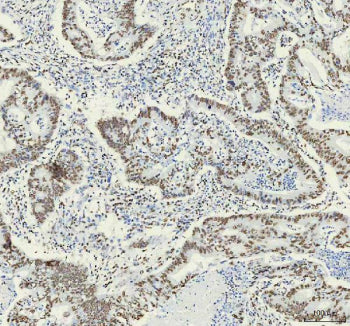 IHC analysis of HNRNPM using anti-HNRNPM antibody. HNRNPM was detected in a paraffin-embedded section of human stomach cancer tissue. Heat mediated antigen retrieval was performed in EDTA buffer (pH 8.0, epitope retrieval solution). The tissue section was blocked with 10% goat serum. The tissue section was then incubated with 1:50 rabbit anti-HNRNPM antibody overnight at 4oC. Peroxidase Conjugated Goat Anti-rabbit IgG was used as secondary antibody and incubated for 30 min at 37oC.