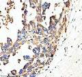Immunohistochemical staining of SPON1 using anti-SPON1 antibody. SPON1 was detected in a paraffin-embedded section of human ovarian cancer tissue. Heat mediated antigen retrieval was performed in EDTA buffer (pH 8.0, epitope retrieval solution). The tissue section was blocked with 10% goat serum. The tissue section was then incubated with 2 ug/ml rabbit anti-SPON1 antibody overnight at 4oC. Peroxidase Conjugated Goat Anti-rabbit IgG was used as secondary antibody and incubated for 30 min at 37oC.