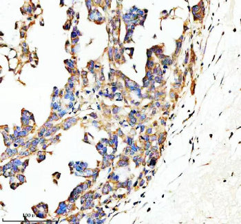 Immunohistochemical staining of SPON1 using anti-SPON1 antibody. SPON1 was detected in a paraffin-embedded section of human ovarian cancer tissue. Heat mediated antigen retrieval was performed in EDTA buffer (pH 8.0, epitope retrieval solution). The tissue section was blocked with 10% goat serum. The tissue section was then incubated with 2 ug/ml rabbit anti-SPON1 antibody overnight at 4oC. Peroxidase Conjugated Goat Anti-rabbit IgG was used as secondary antibody and incubated for 30 min at 37oC.