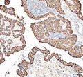 IHC staining of FFPE human thyroid cancer tissue with PPA2 antibody. HIER: boil tissue sections in pH8 EDTA for 20 min and allow to cool before testing.