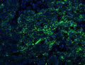 Immunofluorescent staining of FFPE human lung cancer with Claudin 1 antibody (green) and DAPI nuclear stain (blue). HIER: steam section in pH8 EDTA for 20 min.
