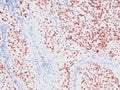 IHC: Formalin-fixed, paraffin-embedded human lung carcinoma stained with NKX2.1 antibody (clone SPM150).