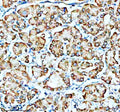 Immunohistochemical staining of SMG8 using anti-SMG8 antibody. SMG8 was detected in a paraffin-embedded section of human stomach cancer tissue. Heat mediated antigen retrieval was performed in EDTA buffer (pH 8.0, epitope retrieval solution). The tissue section was blocked with 10% goat serum. The tissue section was then incubated with 2 ug/ml rabbit anti-SMG8 antibody overnight at 4oC. Peroxidase Conjugated Goat Anti-rabbit IgG was used as secondary antibody and incubated for 30 min at 37oC.