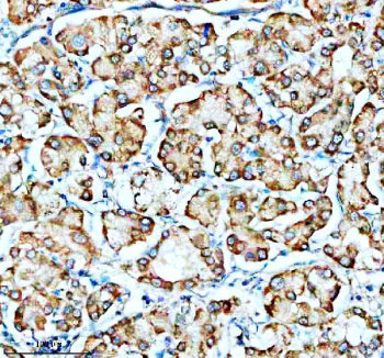Immunohistochemical staining of SMG8 using anti-SMG8 antibody. SMG8 was detected in a paraffin-embedded section of human stomach cancer tissue. Heat mediated antigen retrieval was performed in EDTA buffer (pH 8.0, epitope retrieval solution). The tissue section was blocked with 10% goat serum. The tissue section was then incubated with 2 ug/ml rabbit anti-SMG8 antibody overnight at 4oC. Peroxidase Conjugated Goat Anti-rabbit IgG was used as secondary antibody and incubated for 30 min at 37oC.