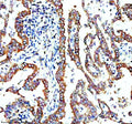 Immunohistochemical staining of TMEM173/STING using anti-STING1 antibody. TMEM173/STING was detected in a paraffin-embedded section of human lung cancer tissue. Heat mediated antigen retrieval was performed in EDTA buffer (pH 8.0, epitope retrieval solution). The tissue section was blocked with 10% goat serum. The tissue section was then incubated with 2 ug/ml rabbit anti-STING1 antibody overnight at 4oC.